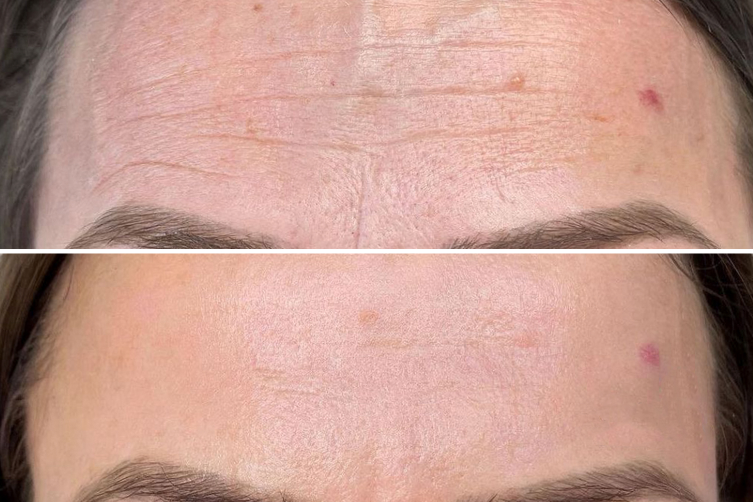 Technicienne PhiIon - Svitlana Bidzilia effectuant un traitement de microneedling. Technicienne PhiIon - Svitlana Bidzilia effectuant un traitement de microneedling.