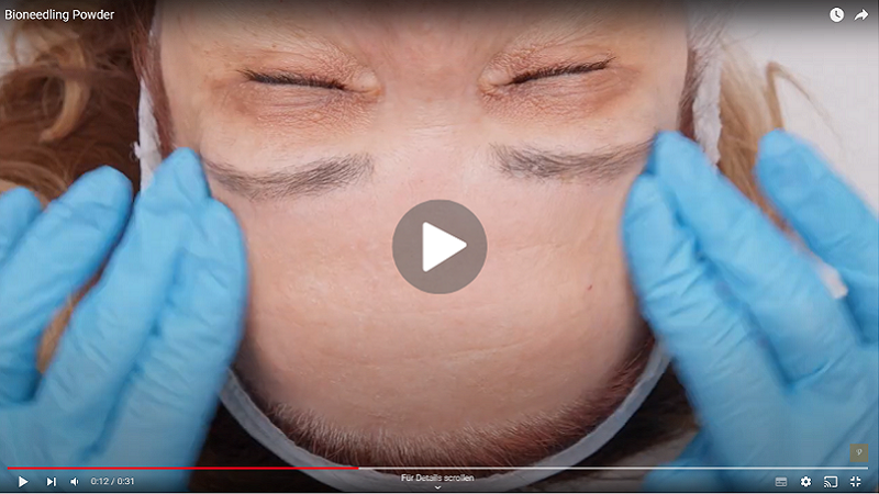 Vidéo sur le traitement par bioneedling, étape par étape Vidéo sur le traitement par bioneedling, étape par étape